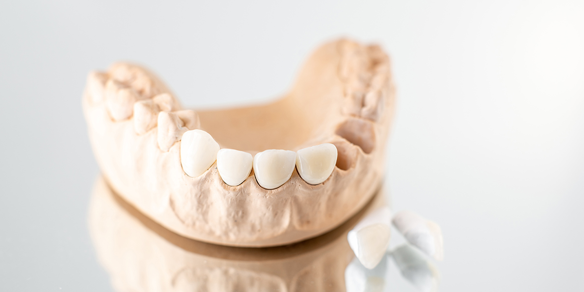 Can You Get Veneers With Missing Teeth? Dental Cosmetics