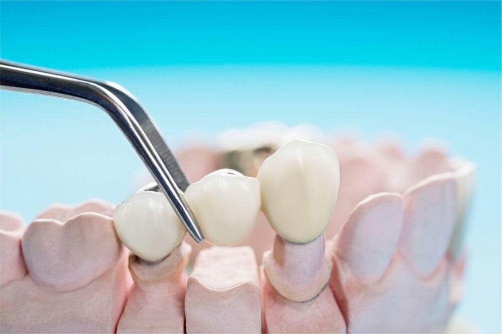 model of a dental bridge being placed in Tucson, AZ