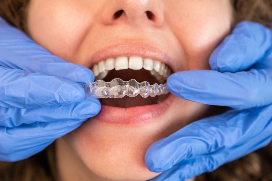 A dentist wearing blue gloves carefully places a clear aligner on a patient's teeth, showcasing an Invisalign-style orthodontic treatment.