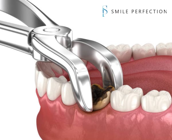 illustration of a tooth extraction in Tucson, AZ