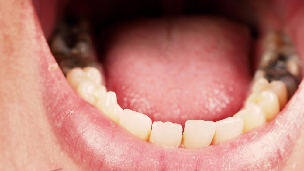 A close-up of a person's open mouth showing misaligned, discolored, and damaged lower teeth, with visible dental fillings on the molars, illustrating what happens if you don’t fill a cavity, including decay and potential tooth damage.